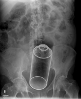 Bad x-rays