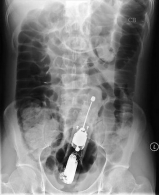 Bad x-rays